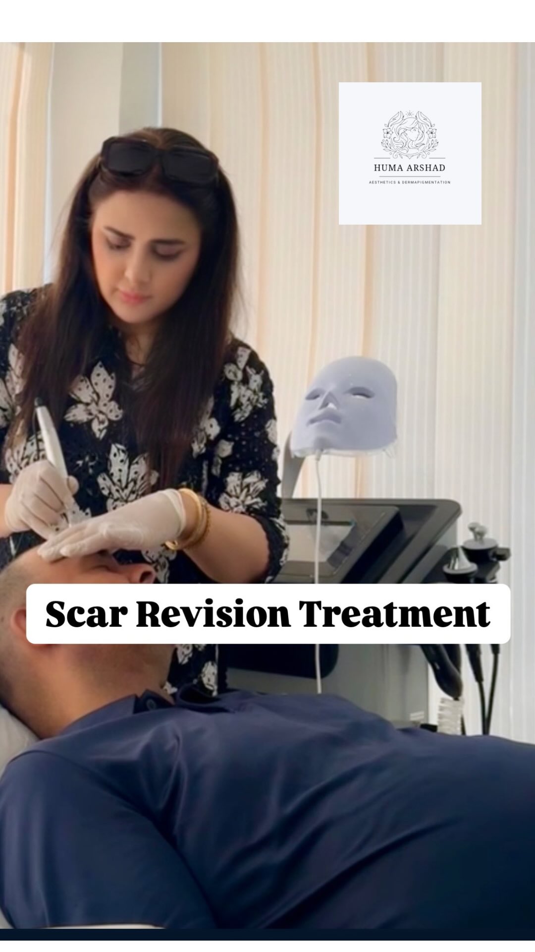 Acne scar treatment result