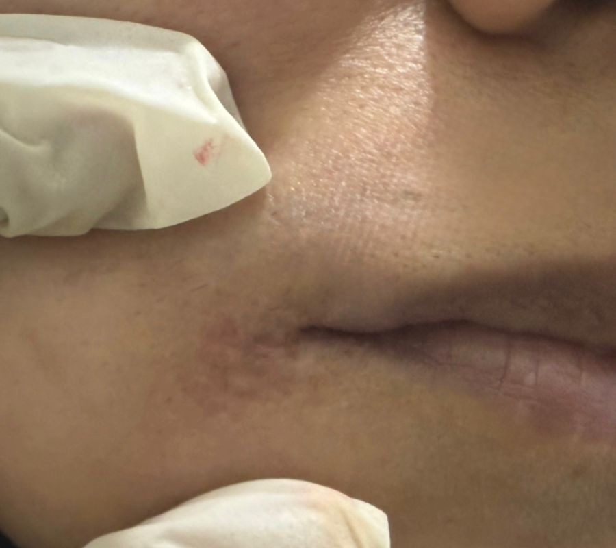 Upper lip scar after treatment