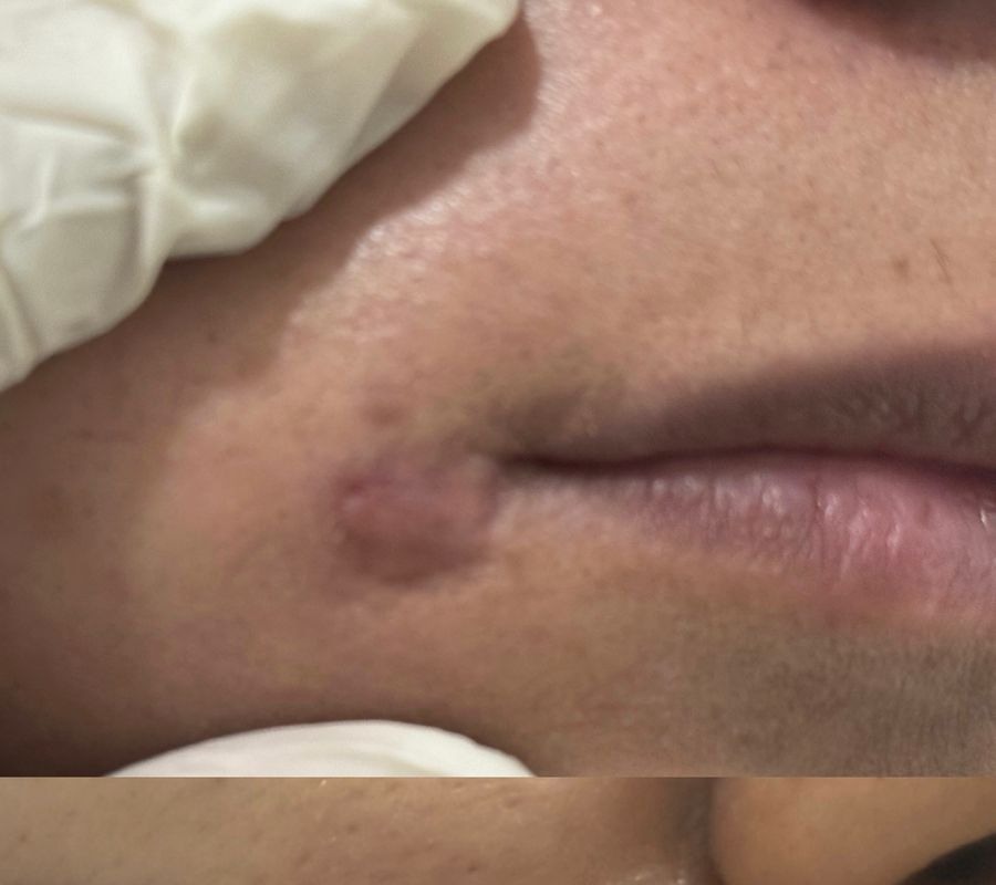 Upper lip scar before treatment